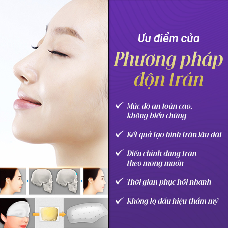 độn trán giá bao nhiêu