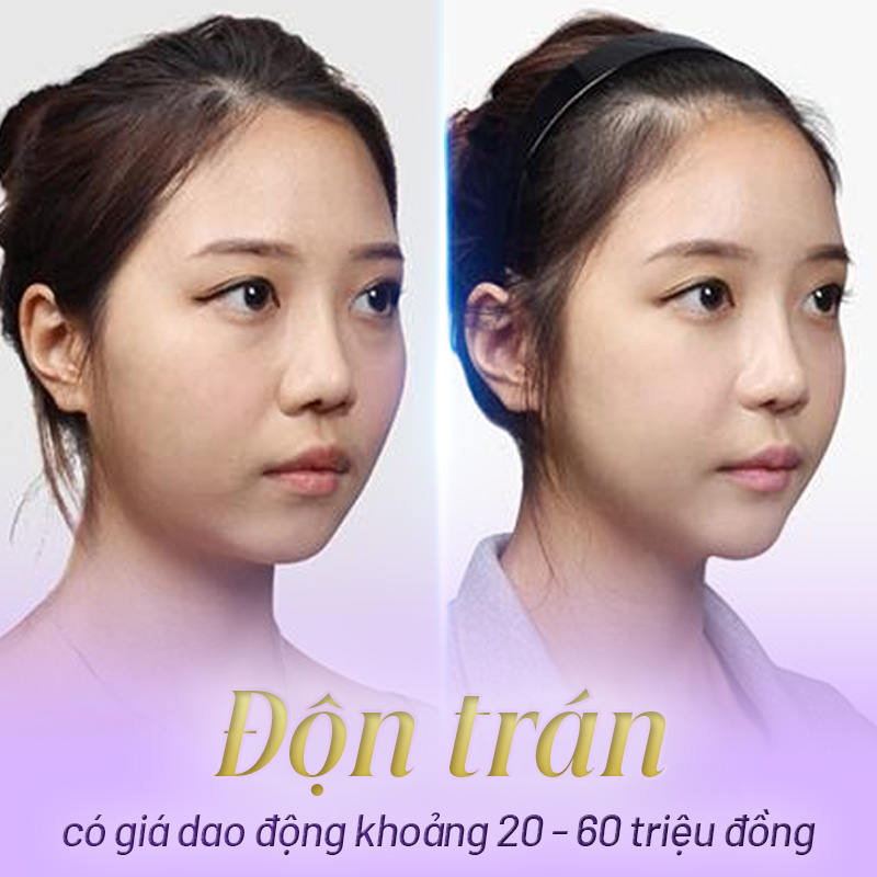 độn trán ở đâu đẹp