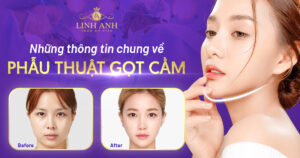 gọt cằm