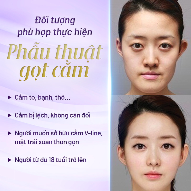 gọt hàm nữ