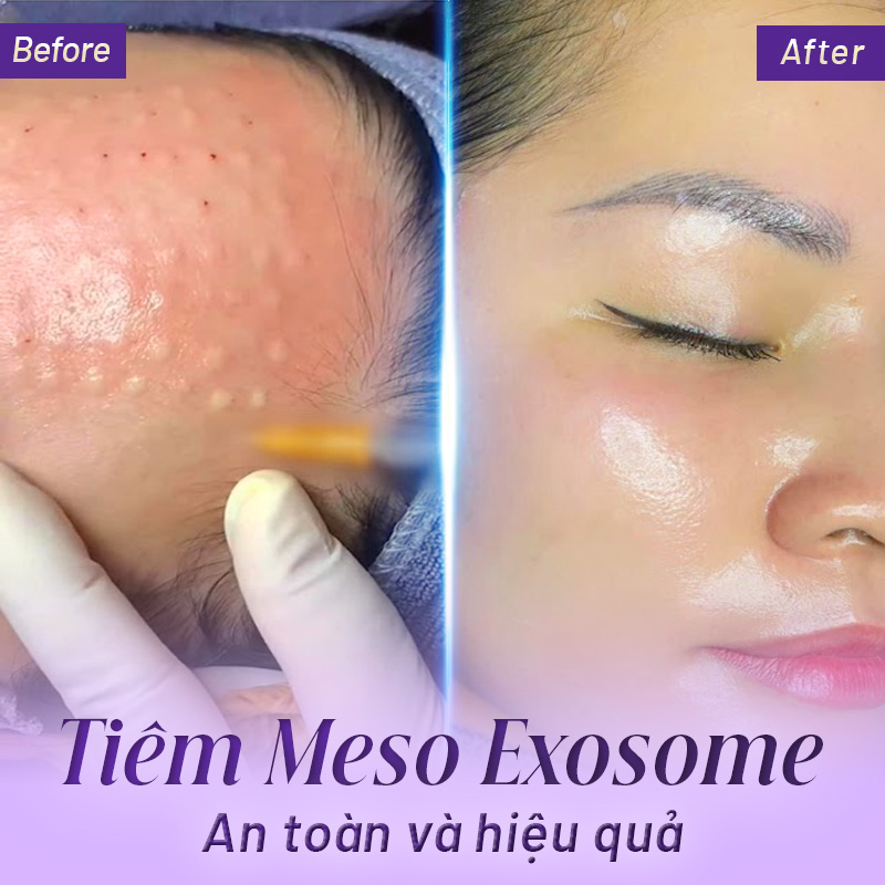 meso exosome asce bao nhiều tiền