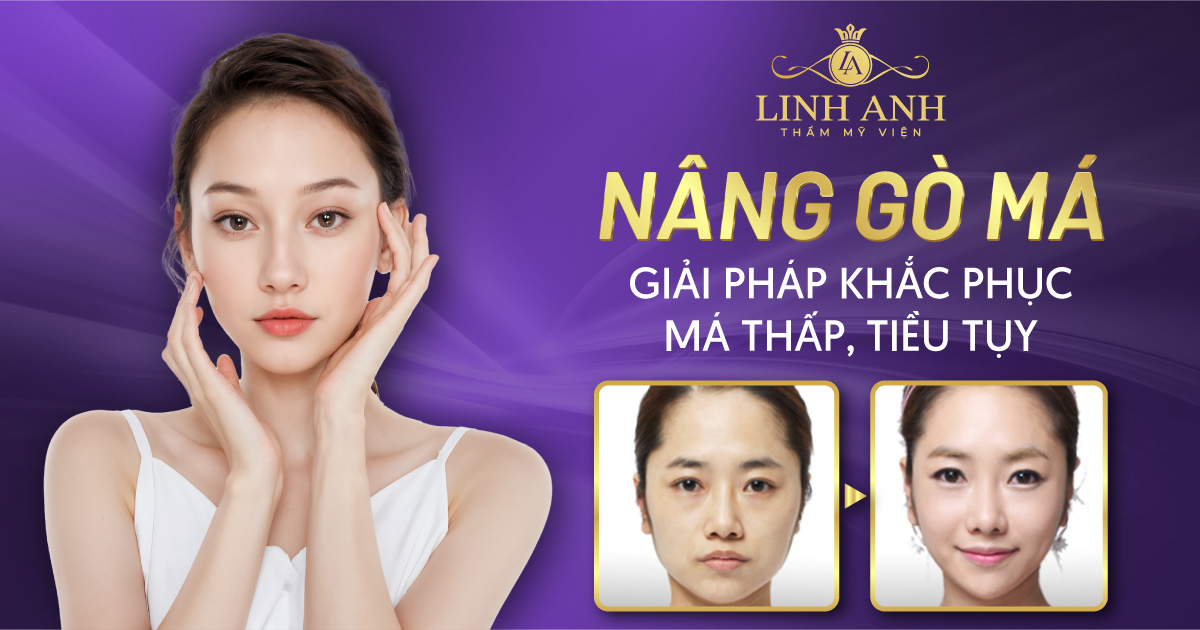 Nâng gò má – Giải pháp khắc phục má thấp, tiều tụy