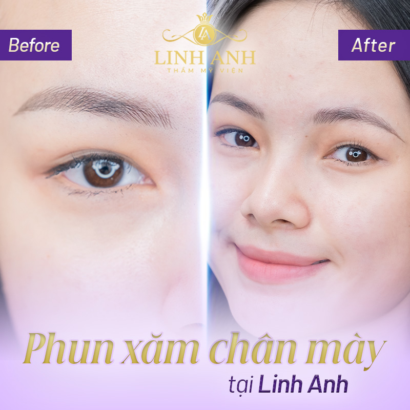 người có lông mày chữ v - Viện thẩm mỹ quốc tế Linh Anh