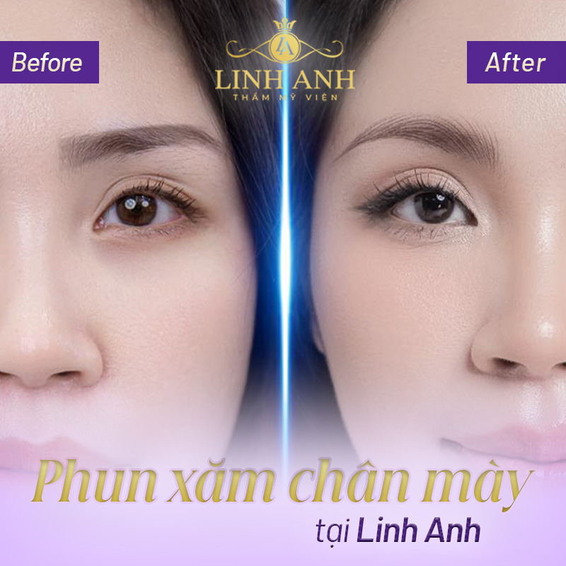 người tướng lông mày chữ v tốt không - Viện thẩm mỹ quốc tế Linh Anh