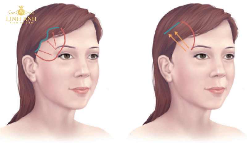 những phương pháp phẫu thuật thẩm mỹ căng da