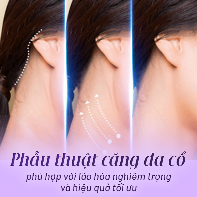 phẫu thuật căng da cổ