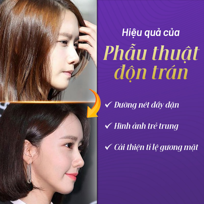 phẫu thuật độn trán ở đâu uy tín