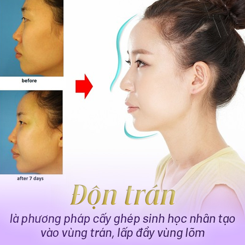 phẫu thuật độn trán