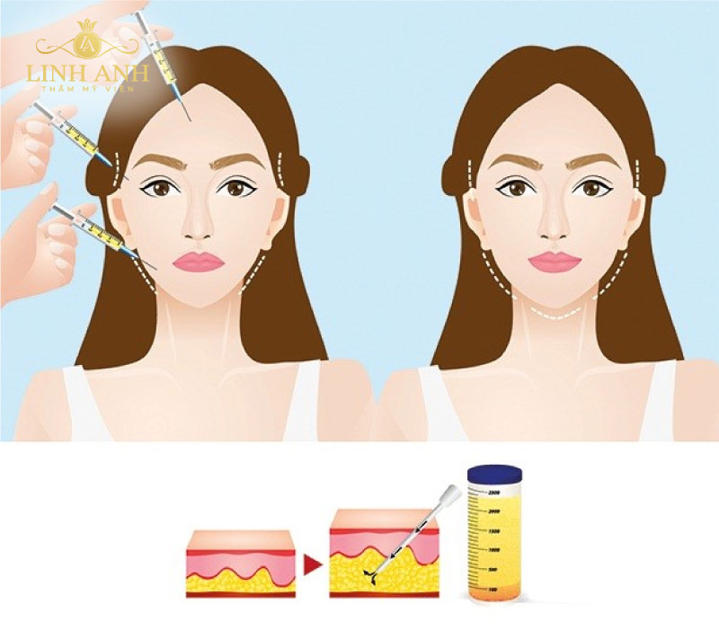 phẫu thuật thẩm mỹ má