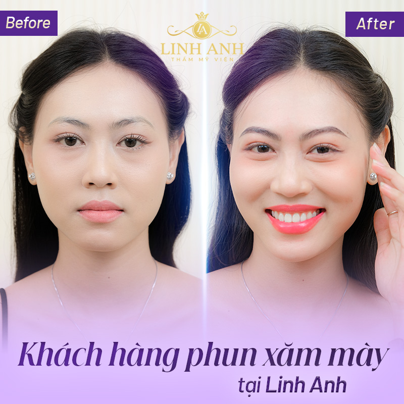 Phun lông mày bị to quá phải làm sao - Viện thẩm mỹ quốc tế Linh Anh