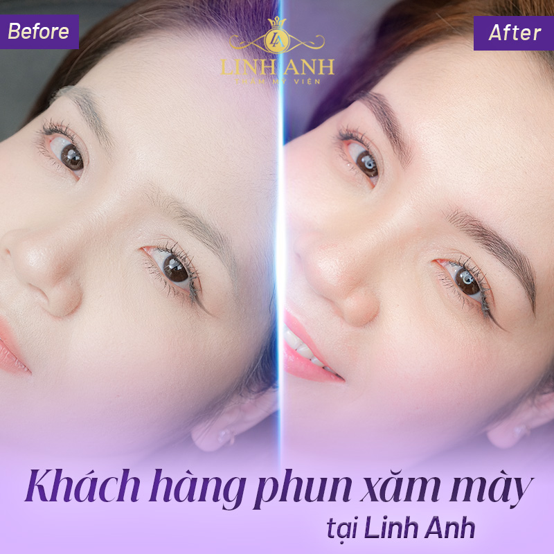 Phun lông mày xong bị to phải làm sao - Viện thẩm mỹ quốc tế Linh Anh