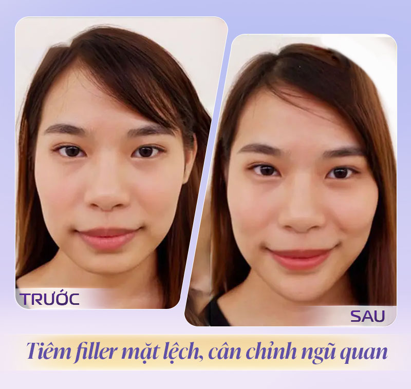 Review tiêm filler mặt lệch