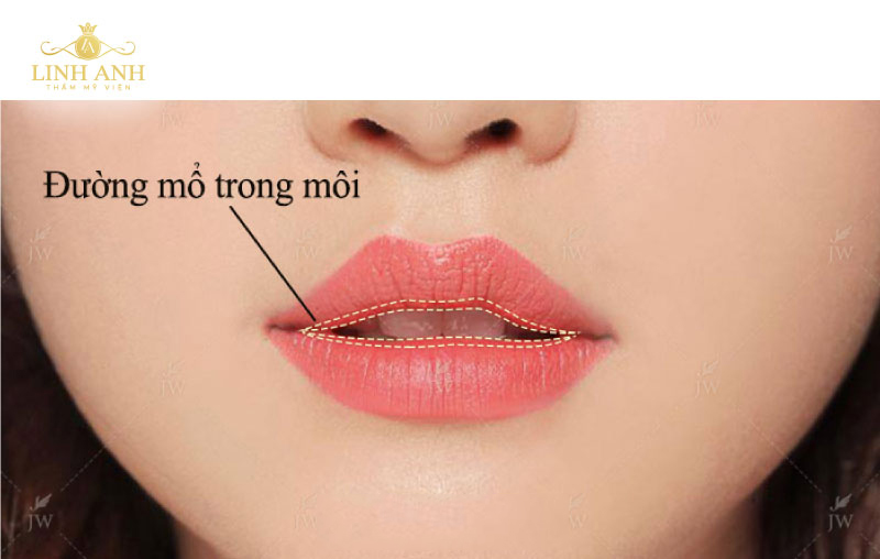 tạo hình thẩm mỹ môi