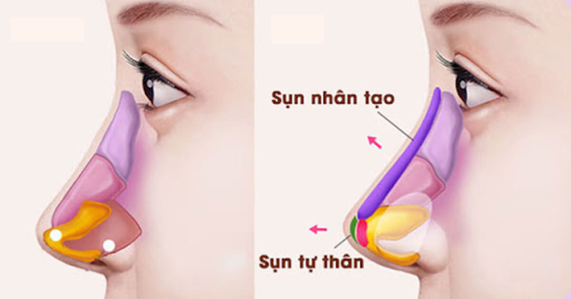 tạo hình thẩm mỹ mũi