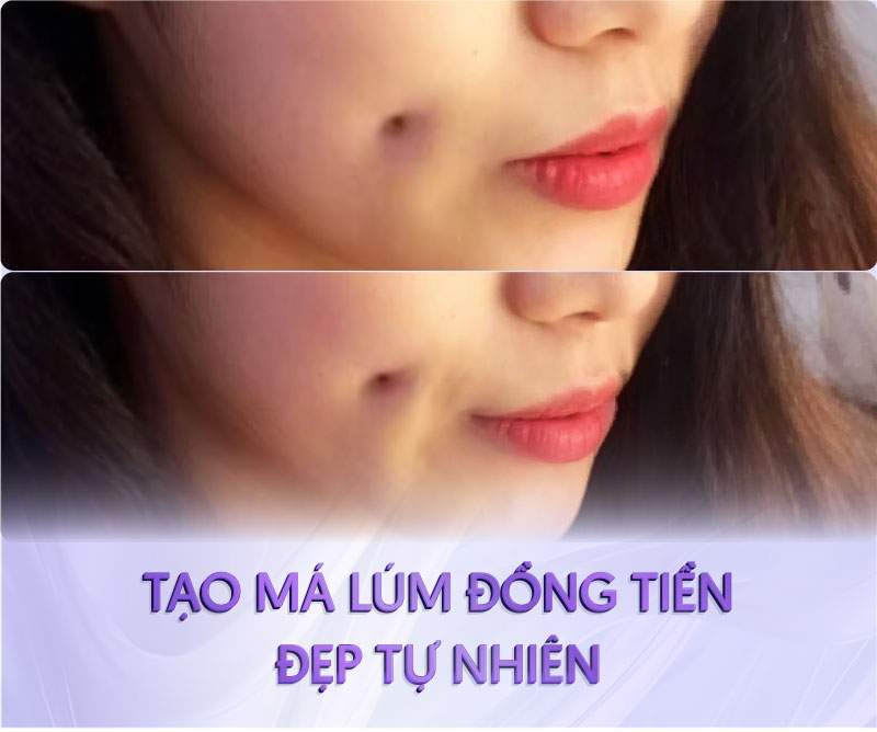 tạo má lúm