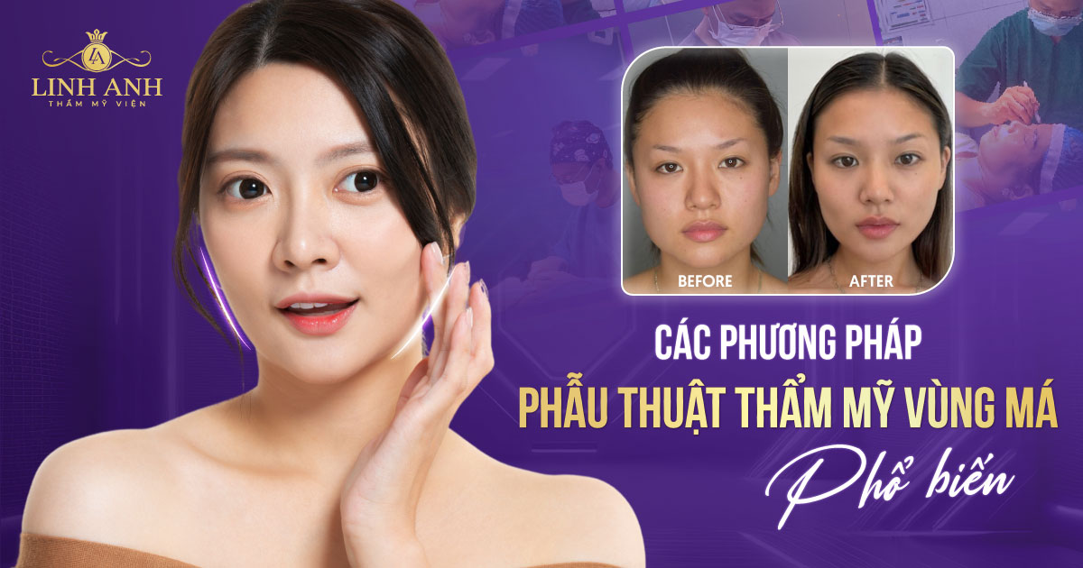 Phẫu thuật thẩm mỹ vùng má: Các phương pháp làm đẹp phổ biến và giá thị trường