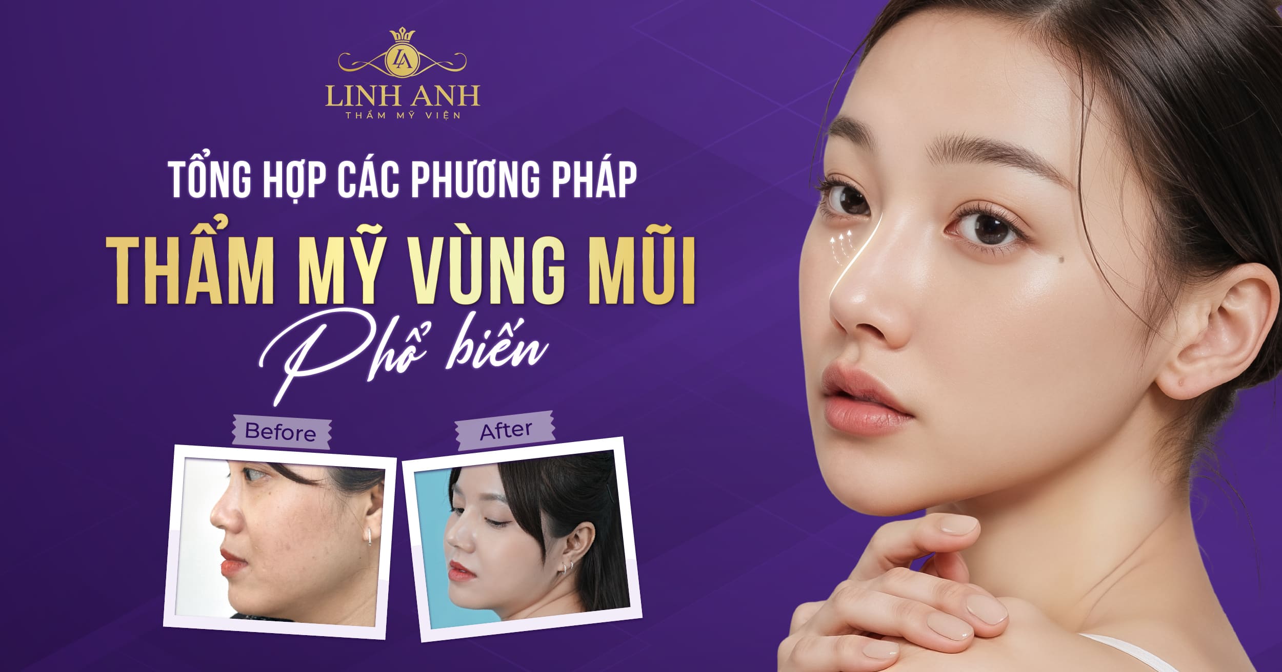 Phẫu thuật thẩm mỹ vùng mũi: Tổng hợp các phương pháp làm đẹp phổ biến và giá thị trường