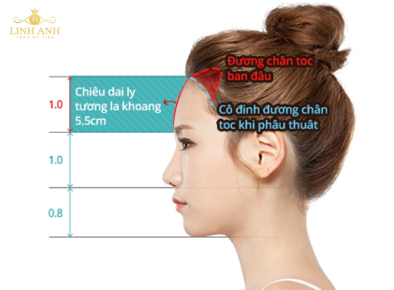 thẩm mỹ vùng trán