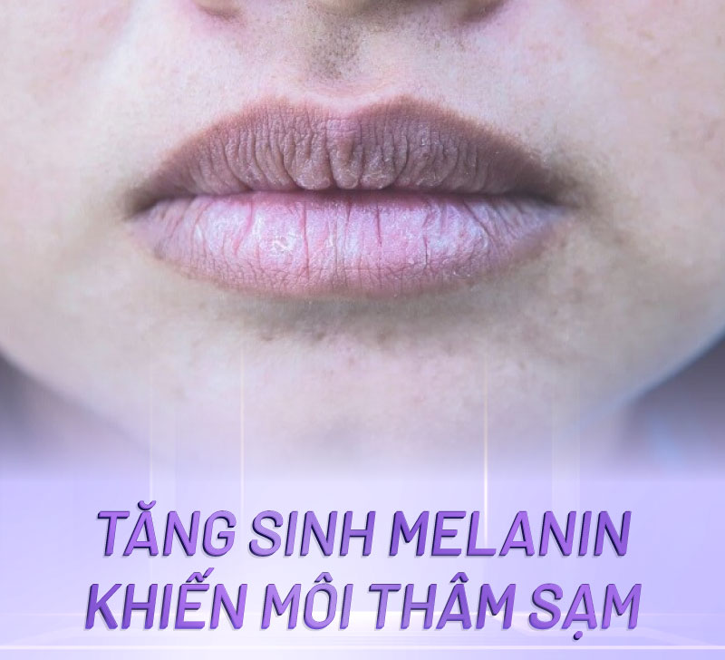 thâm viền môi bẩm sinh phải làm sao