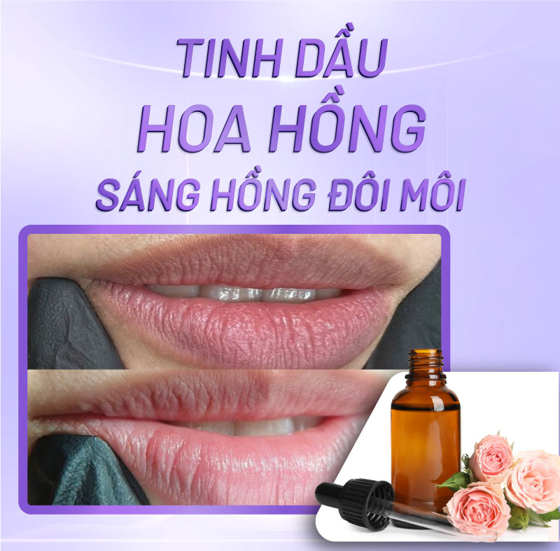 thâm viền môi bẩm sinh