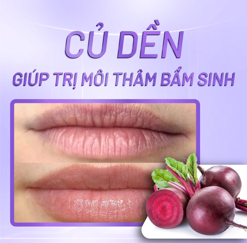 trị môi thâm bẩm sinh