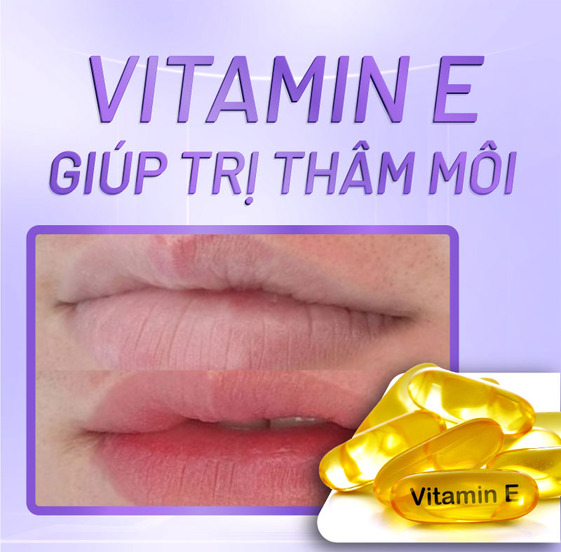 trị thâm viền môi bẩm sinh