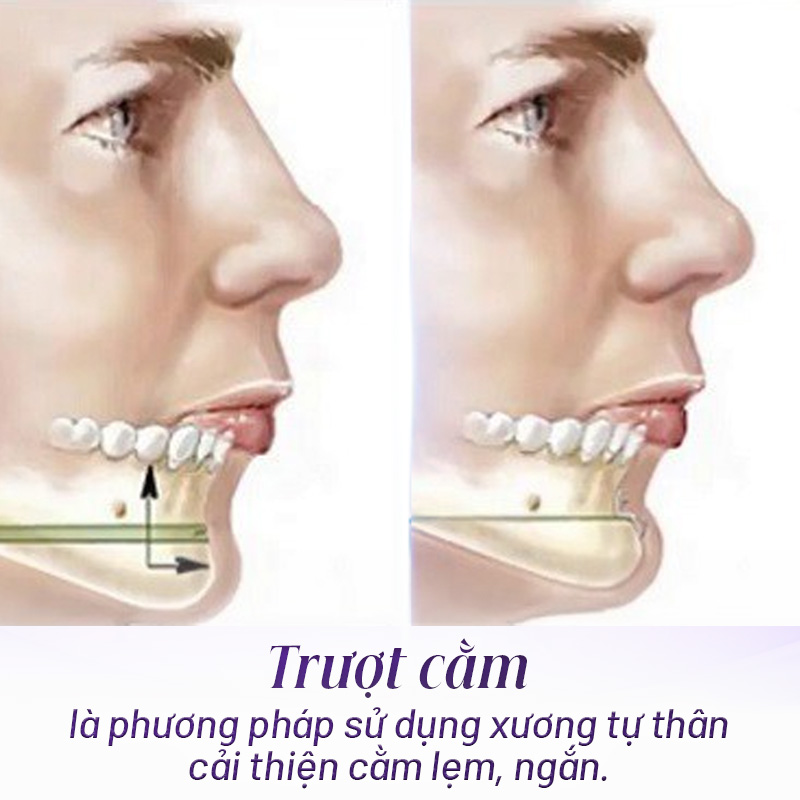 trượt cằm là gì