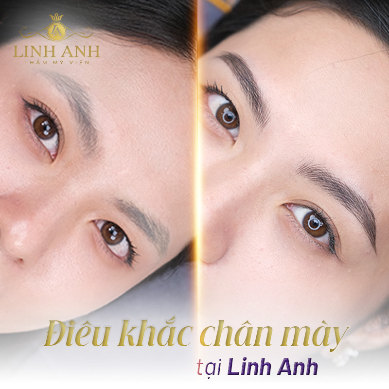 tướng lông mày bị đứt đoạn - Viện thẩm mỹ quốc tế Linh Anh