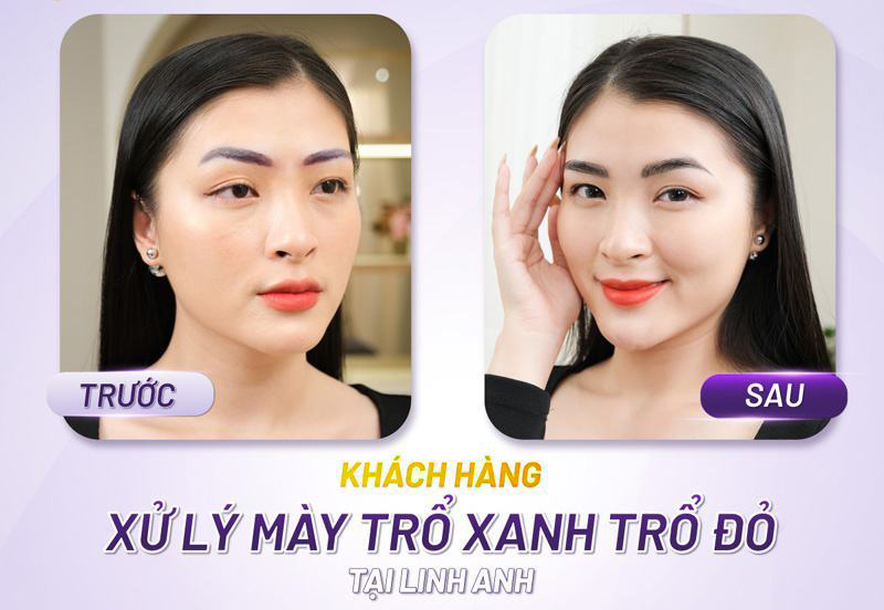 Xử lý lông mày trổ xanh trổ đỏ