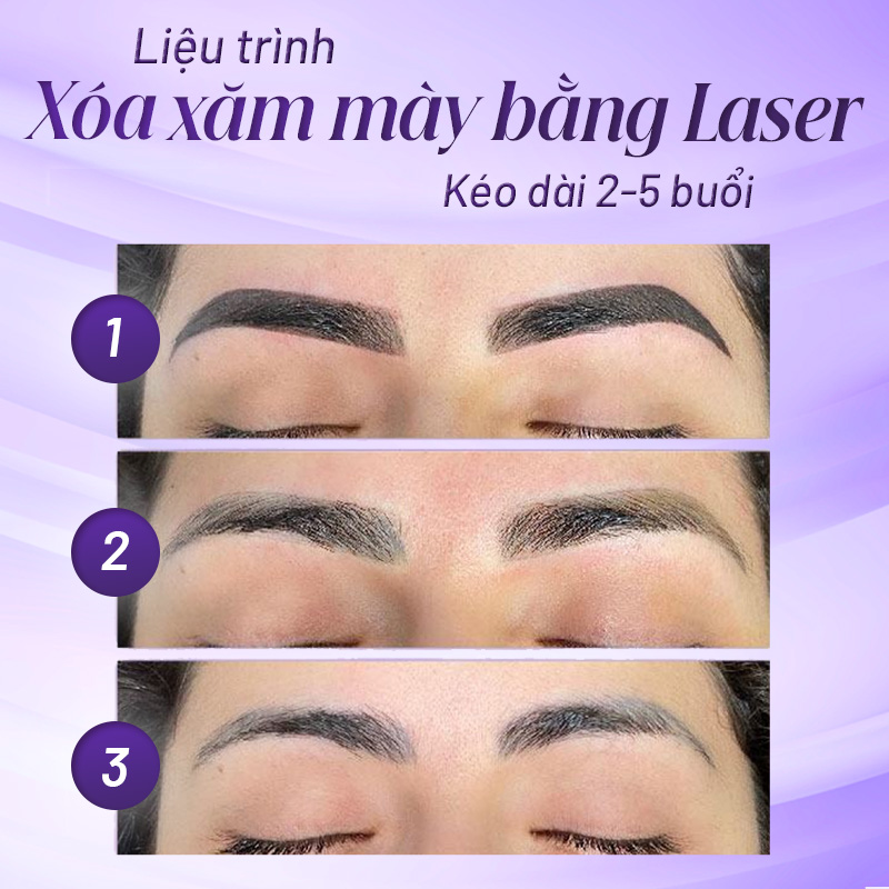 Bắn laser chân mày