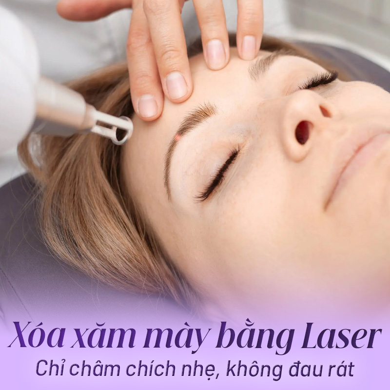 Bắn laser xoá xăm lông mày