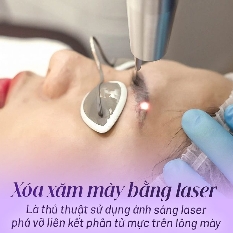 Xoá chân mày bằng laser có hết không