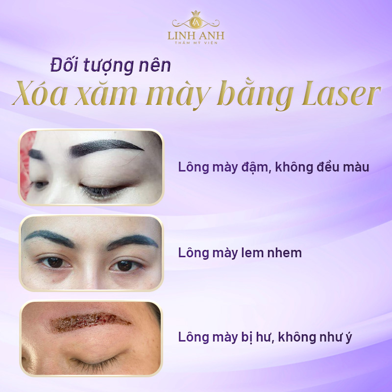 Xoá chân mày xăm bằng laser