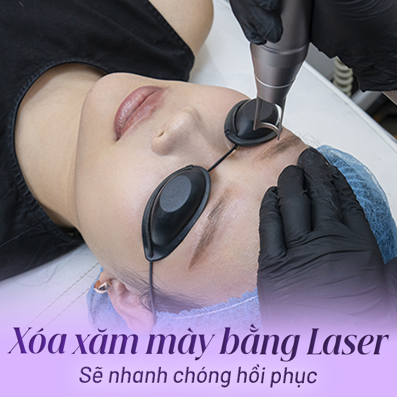 Xoá mày bằng laser