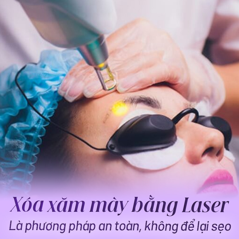 Xóa xăm chân mày bằng laser