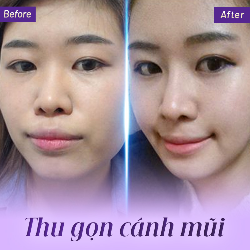 cắt cánh mũi ảnh hưởng gì đến tướng số