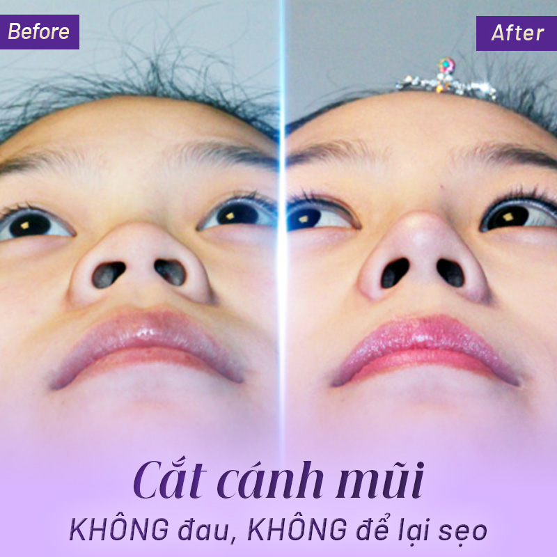 cắt cánh mũi có đau không