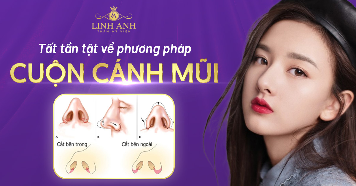 Cắt cánh mũi là gì? Có làm mũi cao hơn không? Giá bao nhiêu?