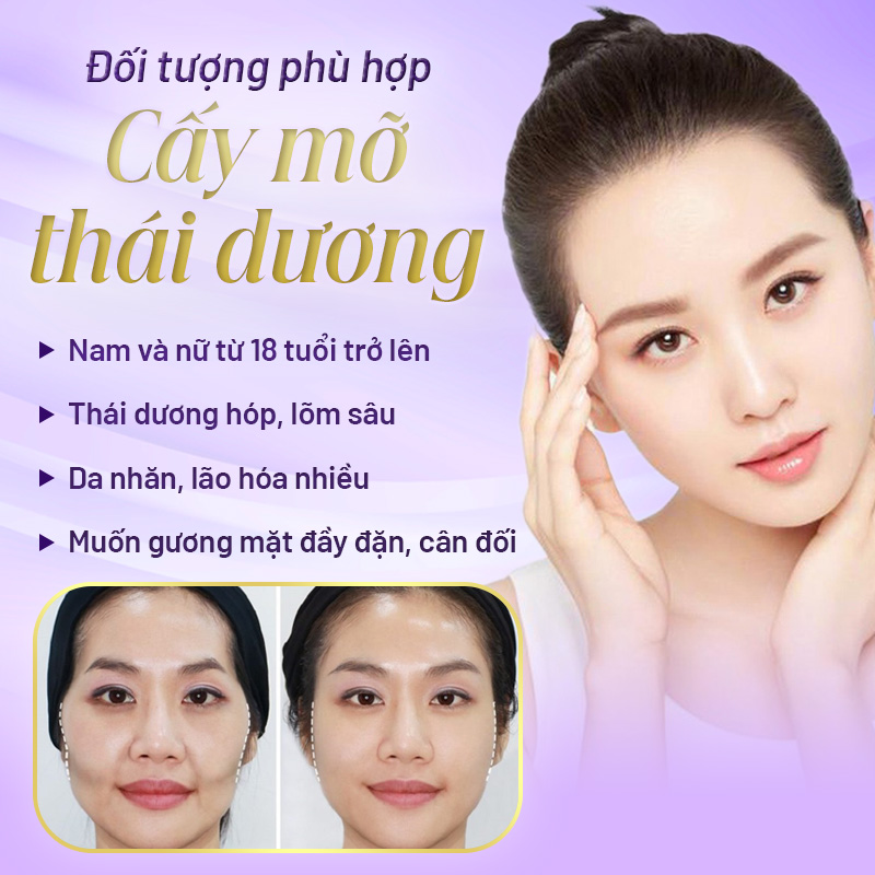 cấy mỡ thái dương được bao lâu