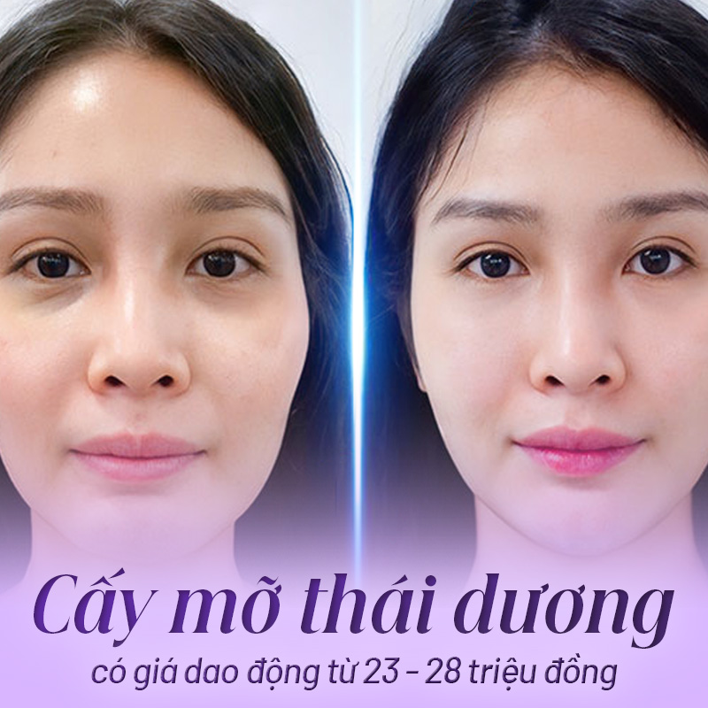 cấy mỡ thái dương giá bao nhiêu