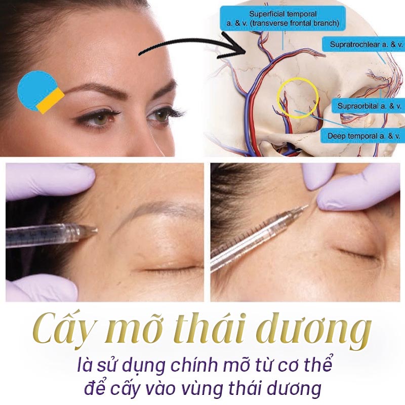 cấy mỡ tự thân thái dương