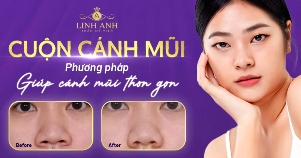 cuộn cánh mũi - Viện thẩm mỹ quốc tế Linh Anh