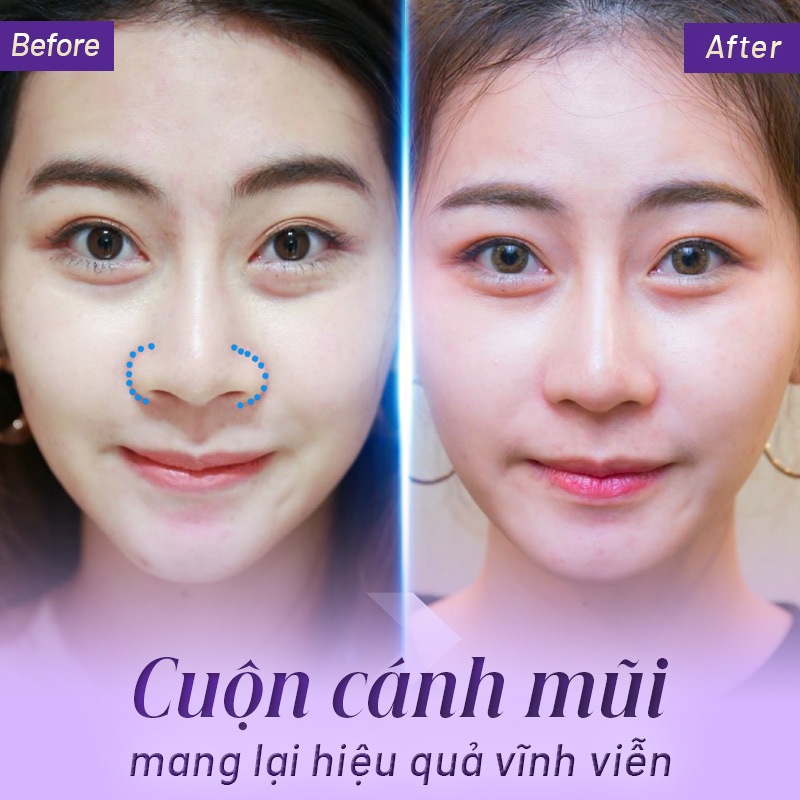 cuộn cánh mũi bao lâu thì lành