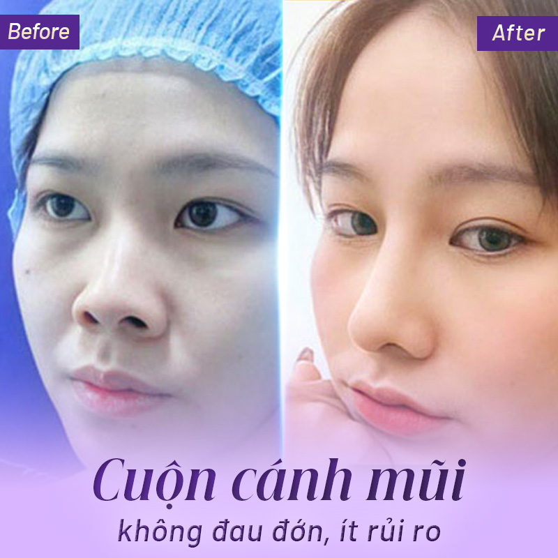 cuộn cánh mũi có đau không