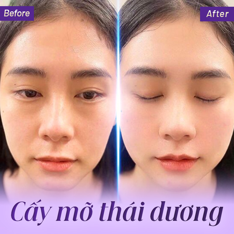 giá cấy mỡ vùng thái dương