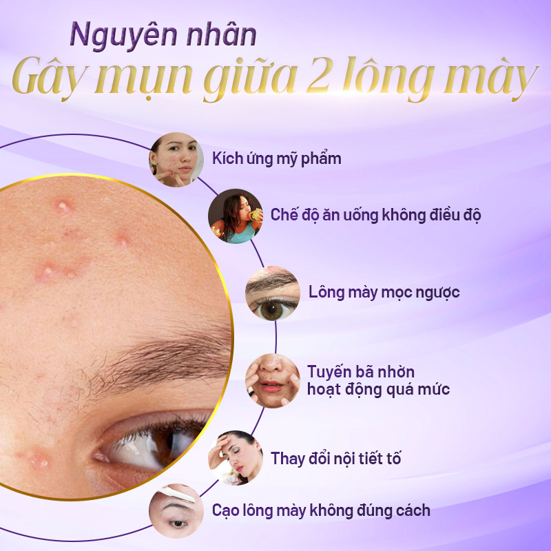 mụn giữa 2 lông mày