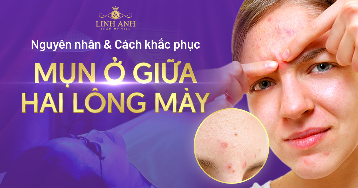 Nguyên nhân & cách khắc phục mụn ở giữa 2 lông mày