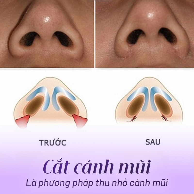 phẫu thuật cắt cánh mũi