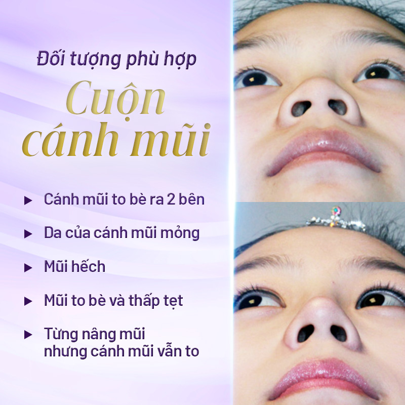 phẫu thuật cuộn cánh mũi