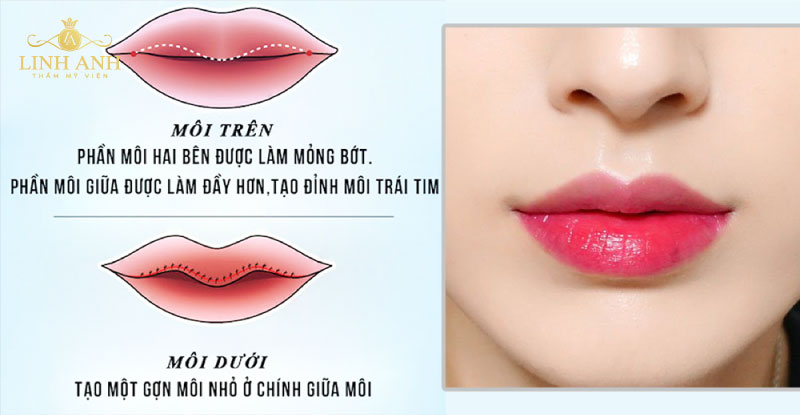 phẫu thuật thẩm mỹ môi